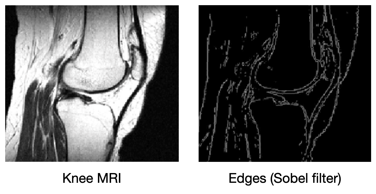 Knee edges