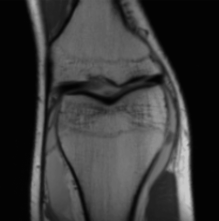 MRI knee reconstruction